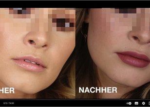 Zwei Fotos einer Jugendlichen. Das Vorher-Foto zeigt das Gesicht mit natürlichen Lippen. Das Nachher-Foto zeigt das Gesicht mit volleren und größeren Lippen.