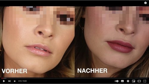 Zwei Fotos einer Jugendlichen. Das Vorher-Foto zeigt das Gesicht mit natürlichen Lippen. Das Nachher-Foto zeigt das Gesicht mit volleren und größeren Lippen.